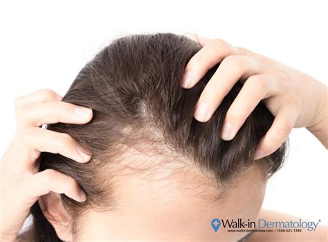 covid  hair loss   side effect  viral infection walk