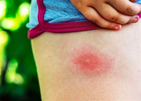 The Bite Of Life How To Tell If You Have Lyme Disease