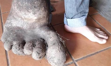 mutant potato grows into shape of human foot in brazil daily star