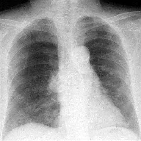 Chest X Ray Demonstrating Multiple Lung Metastases Of Sarcoma And A