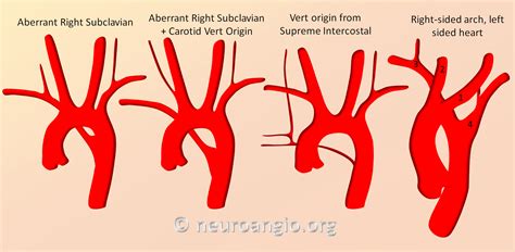 aortic arch neuroangioorg