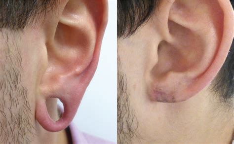 stretched earlobe reconstruction yorkshire skin surgery