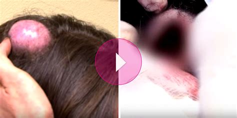 see this woman s 20 year old egg size head cyst get ripped off in 1 piece