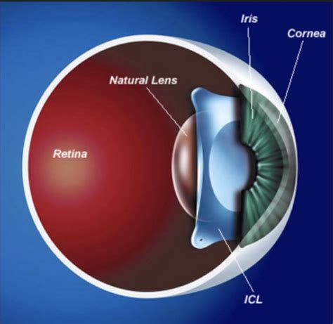implantable contact lens icl specialist manhattan ny long beach ca randa garrana md