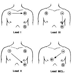 heart monitor lead placement atilaflower