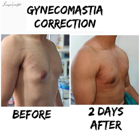 Which Surgeon Is Best For Gynecomastia By Langersculpt Issuu