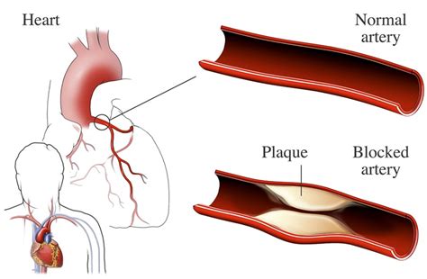 coronary heart disease   risk factors nhlbi nih