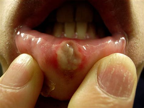 How To Prevent Canker Sores A Checklist For Good Health