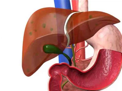 Liver Cirrhosis Ayurgem Ayurveda Treatment Kerala