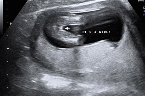 Is This Obvious Girl At 14weeks In Ultrasound Gender