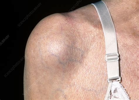 bursitis causing shoulder swelling in old woman stock