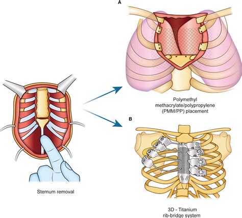 frontiers  sternum reconstruction present  future perspectives