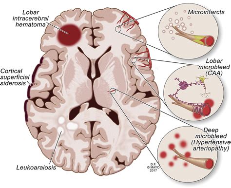 cerebral amyloid angiopathy diagnosis clinical implications