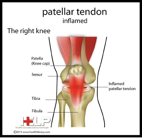 patellar tendon inflamed knee pain relief knee injury general