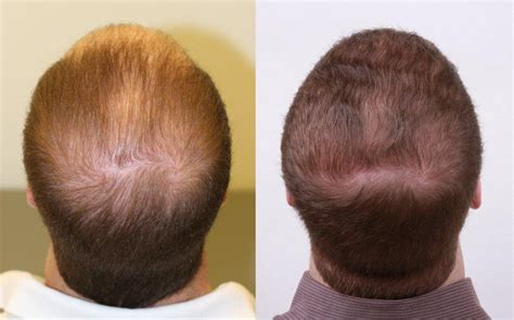 beta sitosterol hair loss