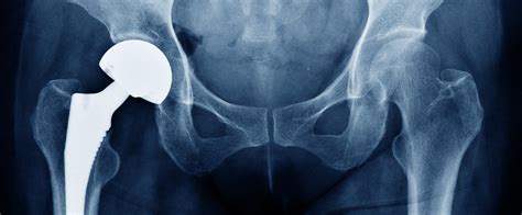 joint replacement justice law fighting