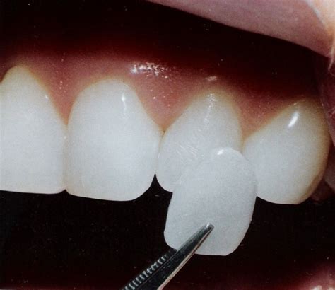 pin op  teeth