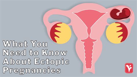 texas ectopic pregnancy diagnosis treatment austin womens health