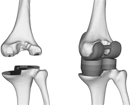 The Fe Model Of The Total Knee Arthroplasty Left The