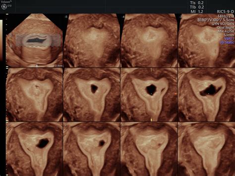 patients prefer transvaginal ultrasound  mri empowered womens health