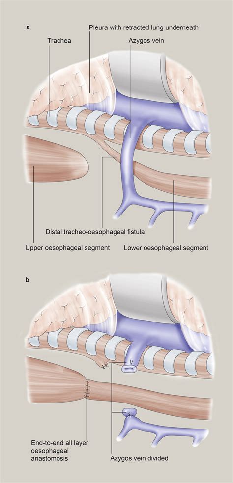 Oesophageal Atresia And Tracheo Oesophageal Fistula Surgery Oxford