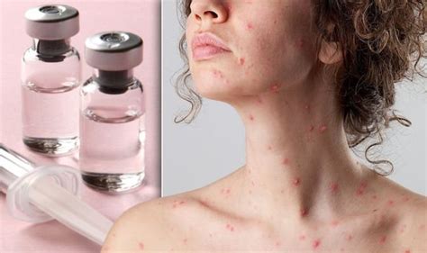 is there a chicken pox vaccine uk