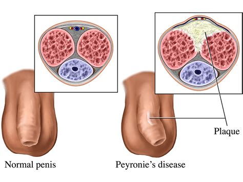 peyronie s disease symptoms and treatments city of hope department of