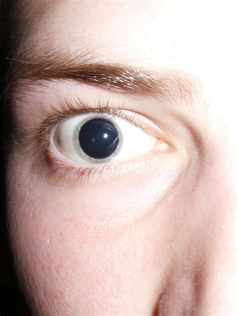 dilated pupils jpg