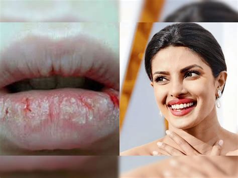 Priyanka Chopra How To Remove Dead Skin From Lips Drink Water Balm Rose