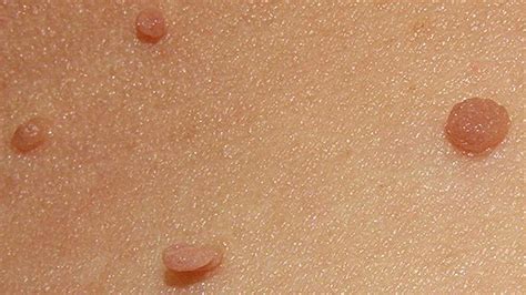 skin tags vs warts how to remove difference