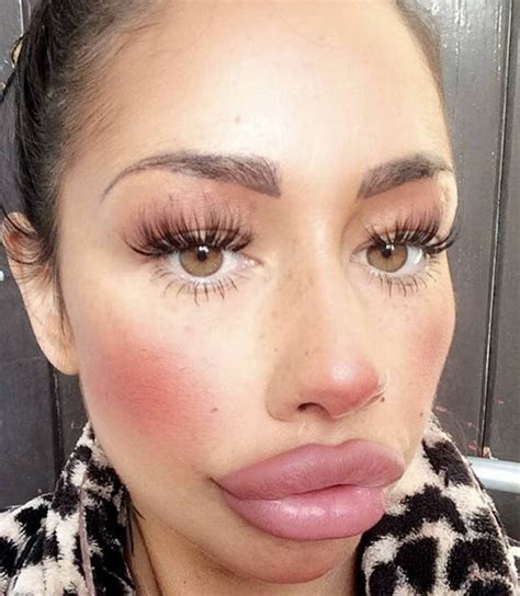 a botox addict and single mum spent £1 600 on getting lip filler and