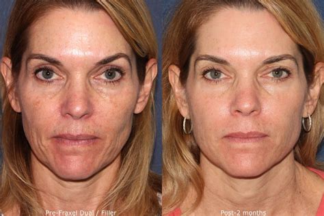 fine lines and wrinkles treatment san diego ca clderm