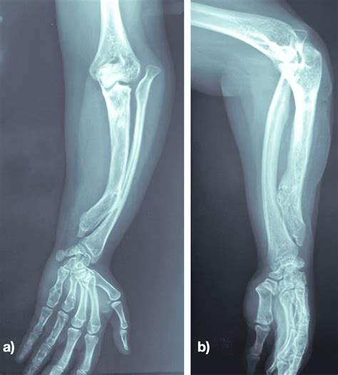 lateral bone   forearm sale cheapest save  jlcatjgobmx