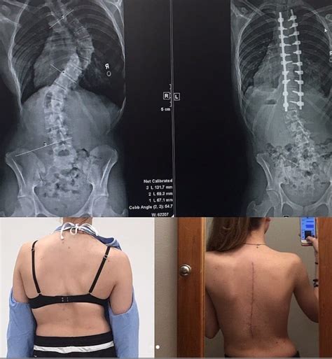 Scoliosis Surgery Before And After Medizzy Journal
