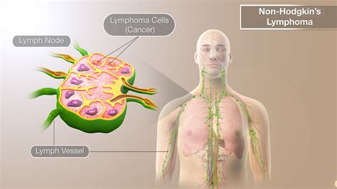 hodgkins lymphoma shown explained  medical animation