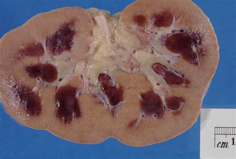 filekidney acute cortical necrosisjpg wikimedia commons