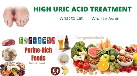 High Uric Acid Treatment What Food To Eat And What To Avoid How To