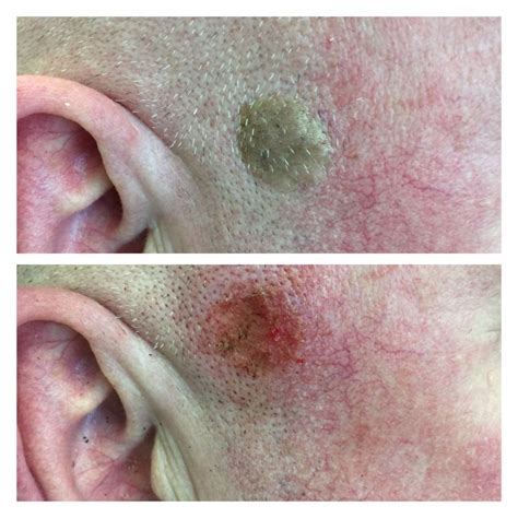 lumps bumps warts removal marsh medical skin clinic
