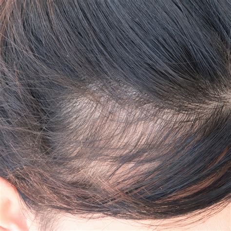 vitamin deficiencies   hair loss  deficiency  important