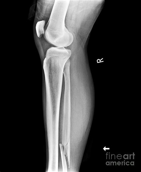 Broken Leg X Ray Photograph By Science Photo Library