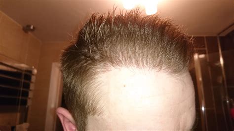 fue post op pictures  months hair transplant story