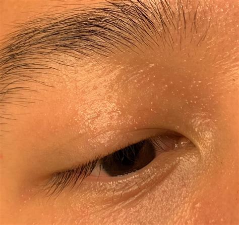 eyelid  slightly swollen   small white bumps