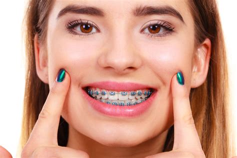 woman smiling showing teeth  braces