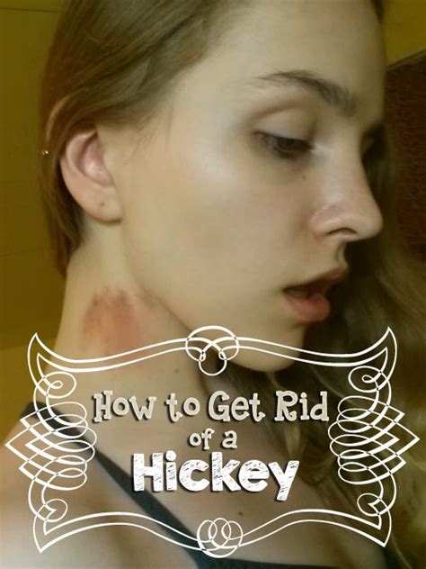 how to get rid of a hickey by get rid of hickies how to hide hickeys hickey mark