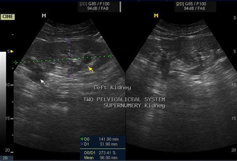 supernumerary kidney ultrasound sumers radiology blog