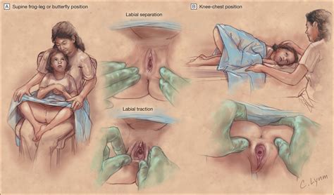 large vaginal vestibule