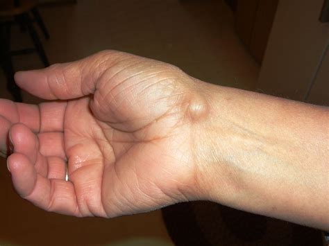 ganglion cyst wikipedia  exact    formation flickr