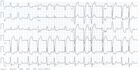 left bundle branch block ifaqsinfrequently asked questions drsvenkatesan md