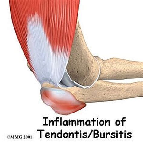 treat bursitis  home healthy living