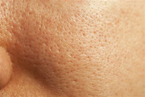 large pores symptoms  skin institute